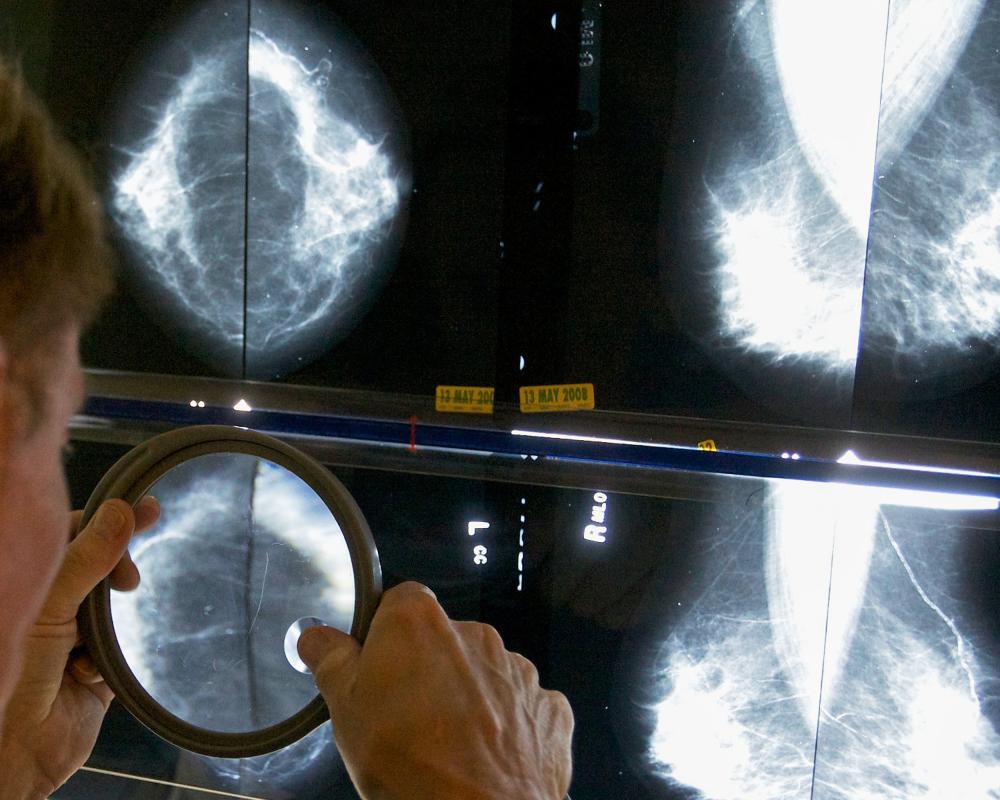 Breast Cancer Guidelines Miss 95% of High-Risk Women Under 50