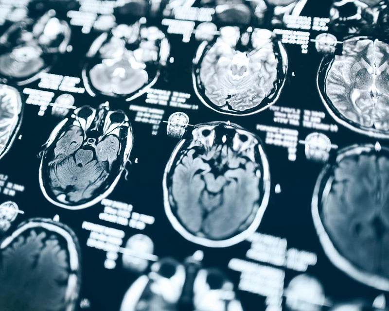 Trump Cuts Halt Alzheimer's Study for 600 Aging Americans