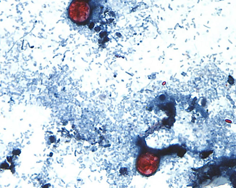 Cyclosporiasis Outbreak Slowing? Test-Makers Hopeful