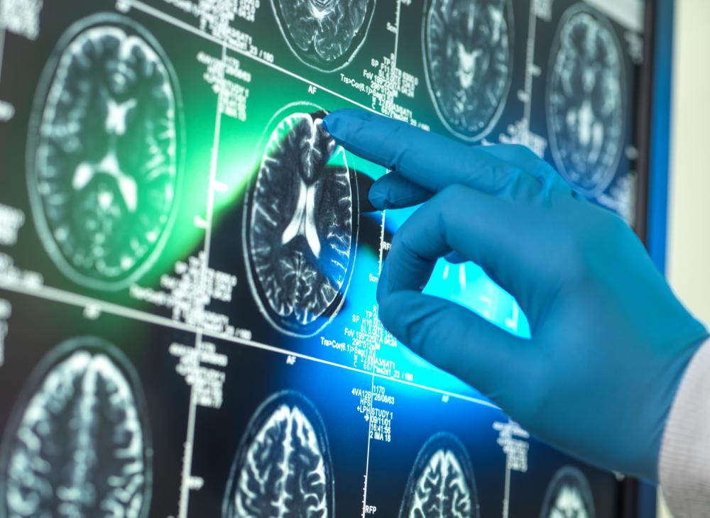 Alzheimer's Research Cuts Threaten Brain Health Progress