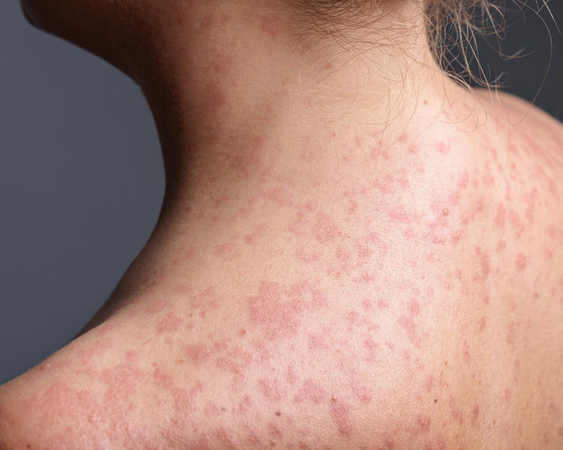 California Measles Warning: Six Counties Exposed on Amtrak Route