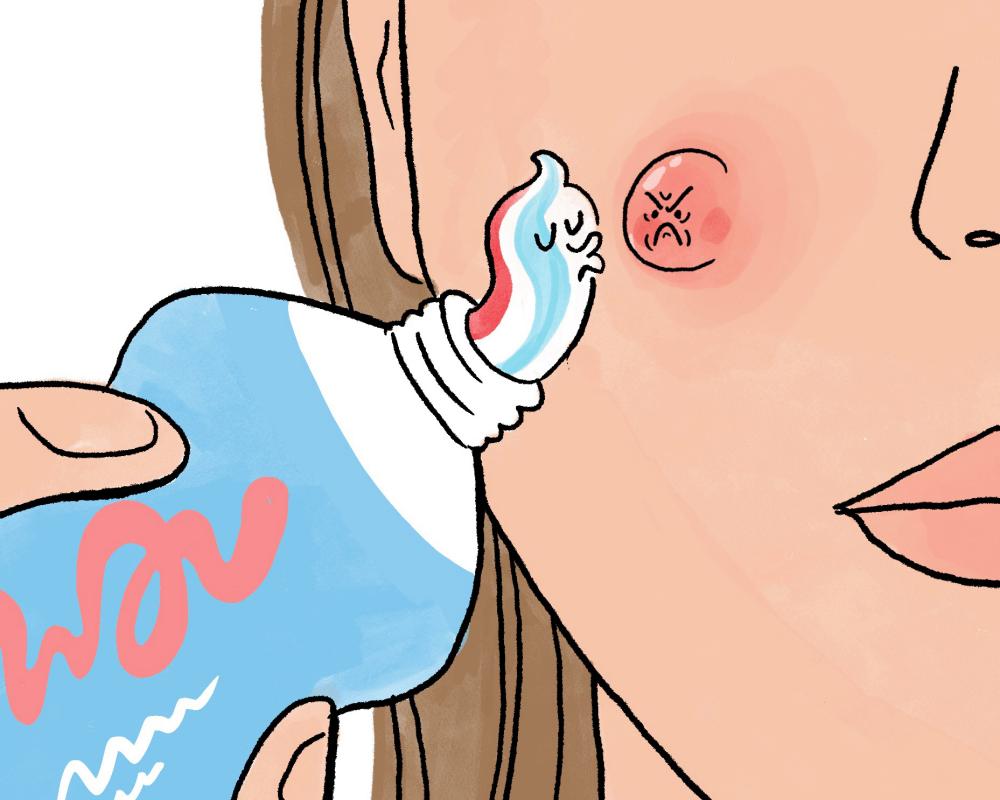 Toothpaste for Spots: Does It Really Work or Make Acne Worse