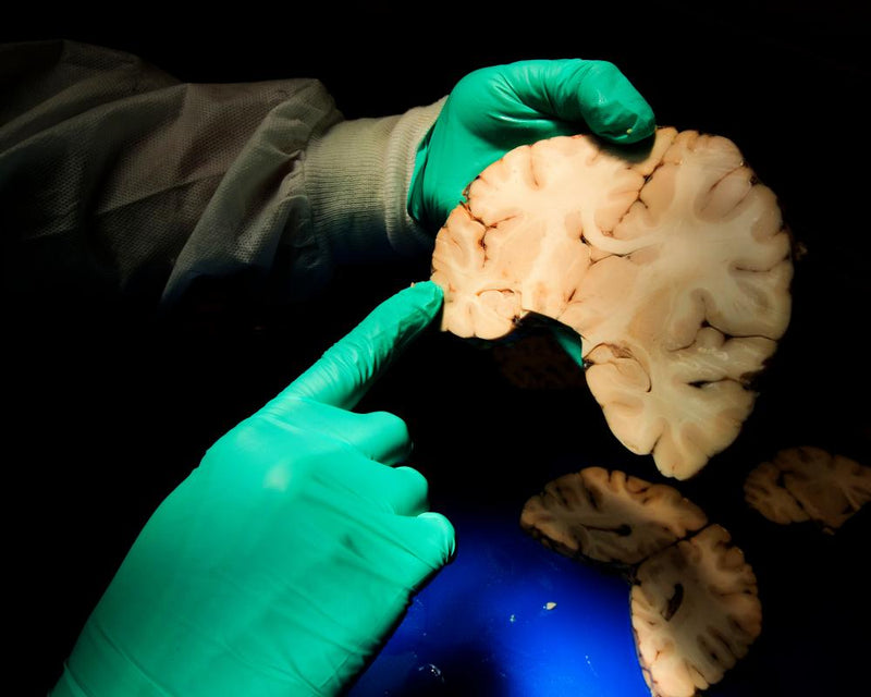 New Study: 75% of Deceased Ex-NFL Players Had CTE Brain Disease