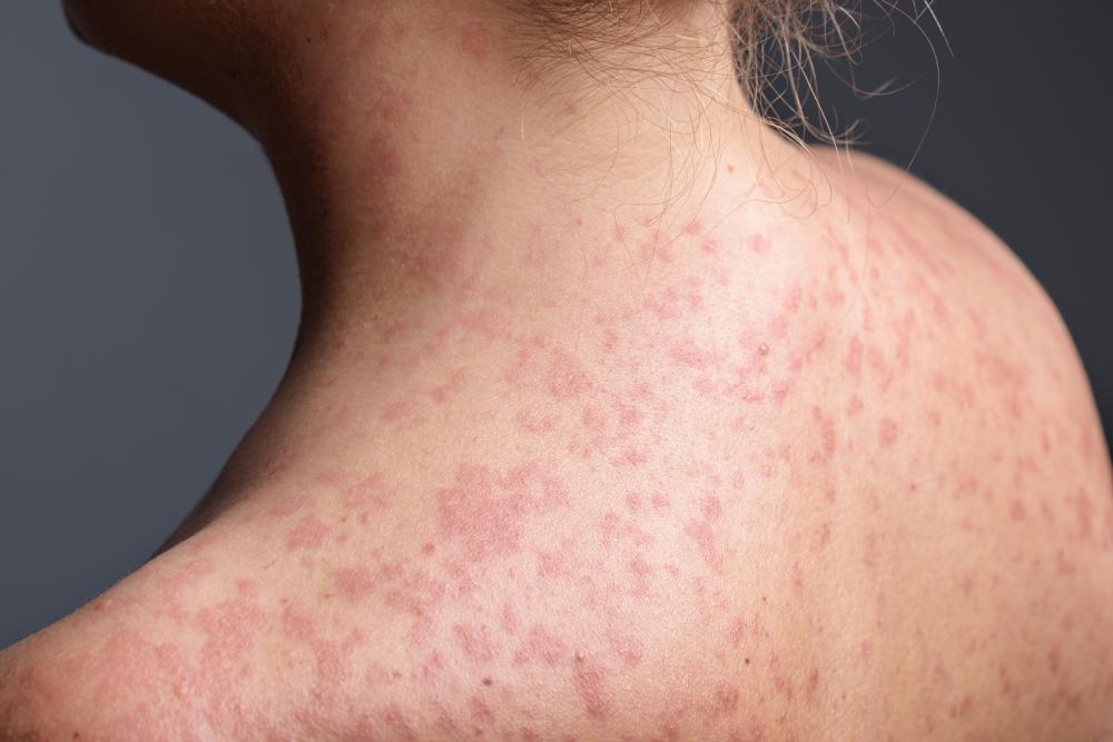Pennsylvania Measles Outbreak: 1,000 Cases Hit Elderly Adults