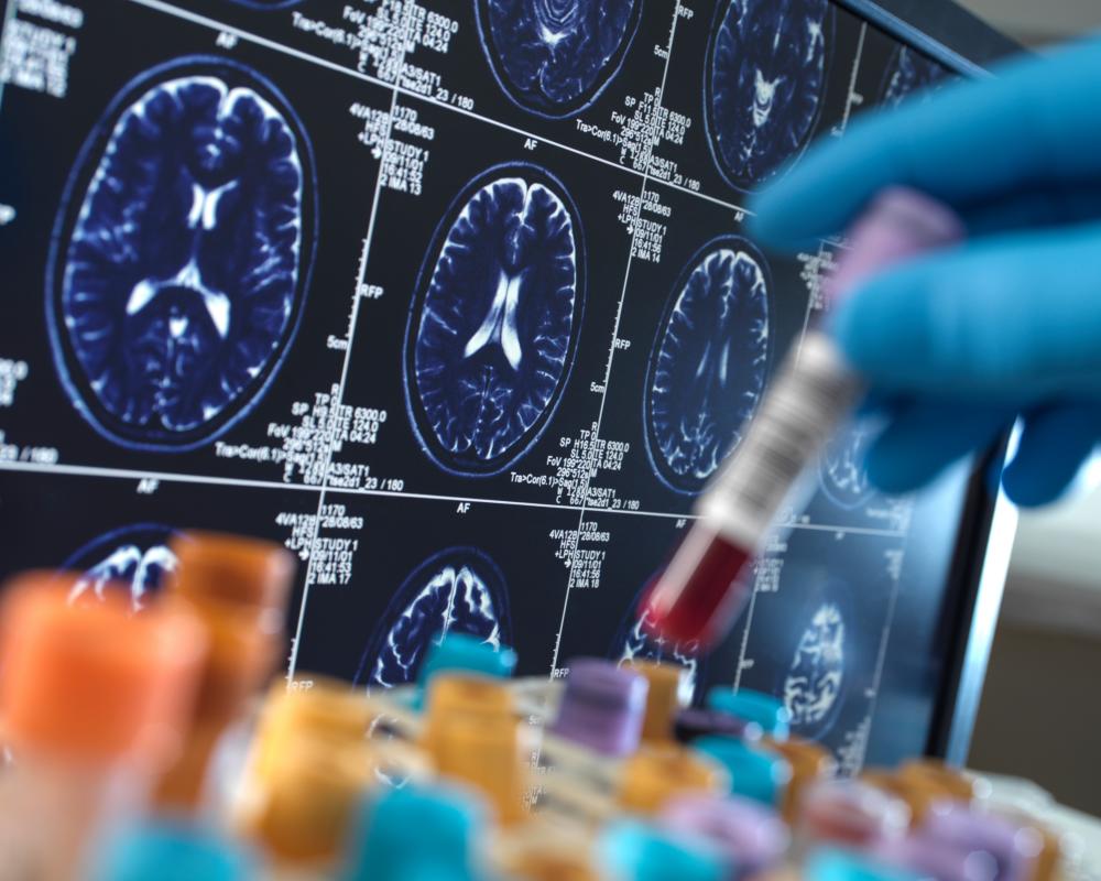 Social Media Misuse of Alzheimer's Blood Tests Raises Alarm
