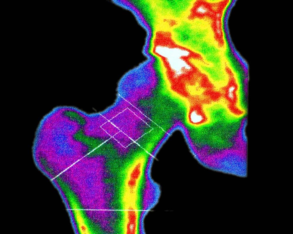 Brittle Bones: How to Know If You Have Osteoporosis
