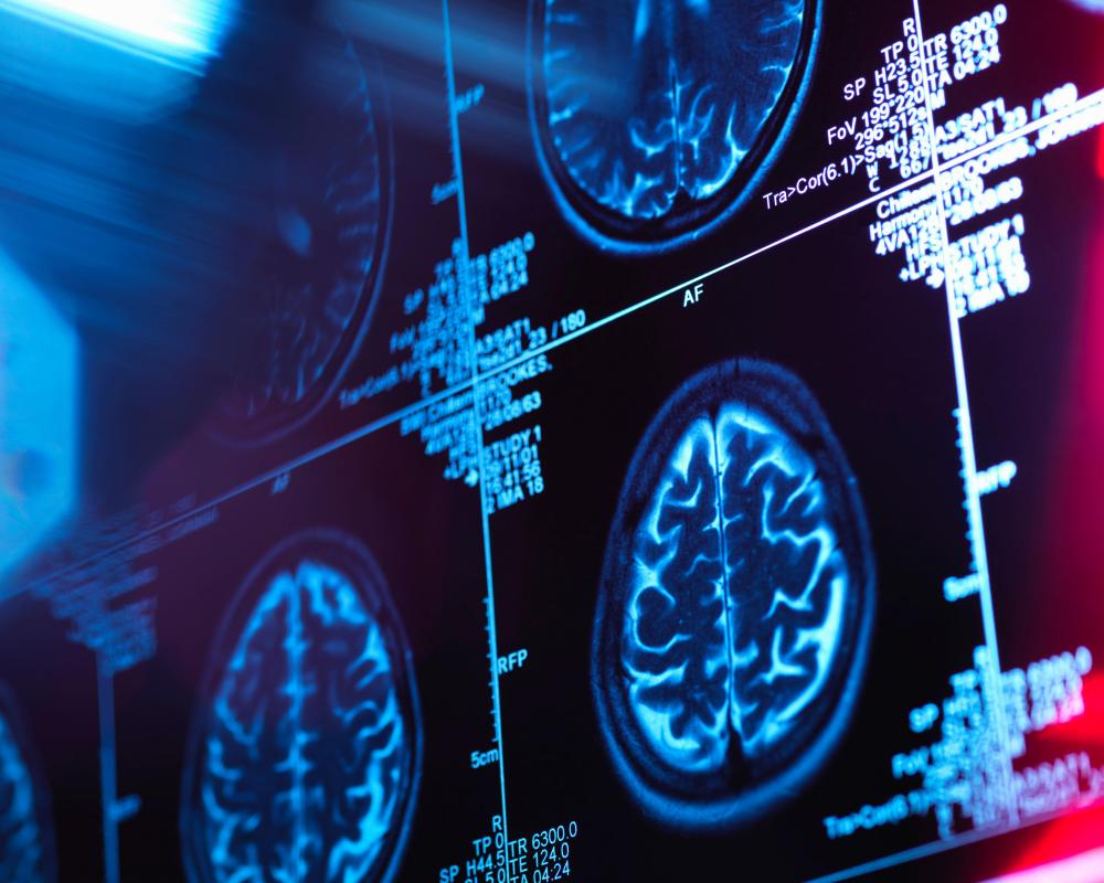 Dementia Language Debate: Why We Must Tell It How