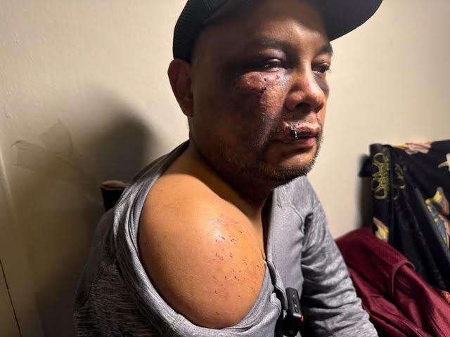 ICE Arrest Leads to Brain Injury and Severe Bruising in Virginia