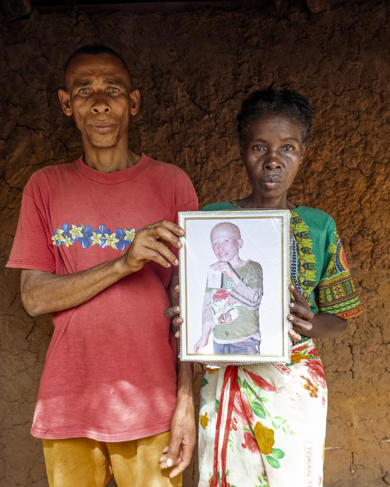 Albinism in Madagascar: Deadly Superstition and Terror