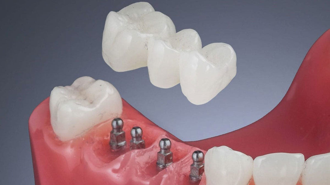Mini Dental Implants