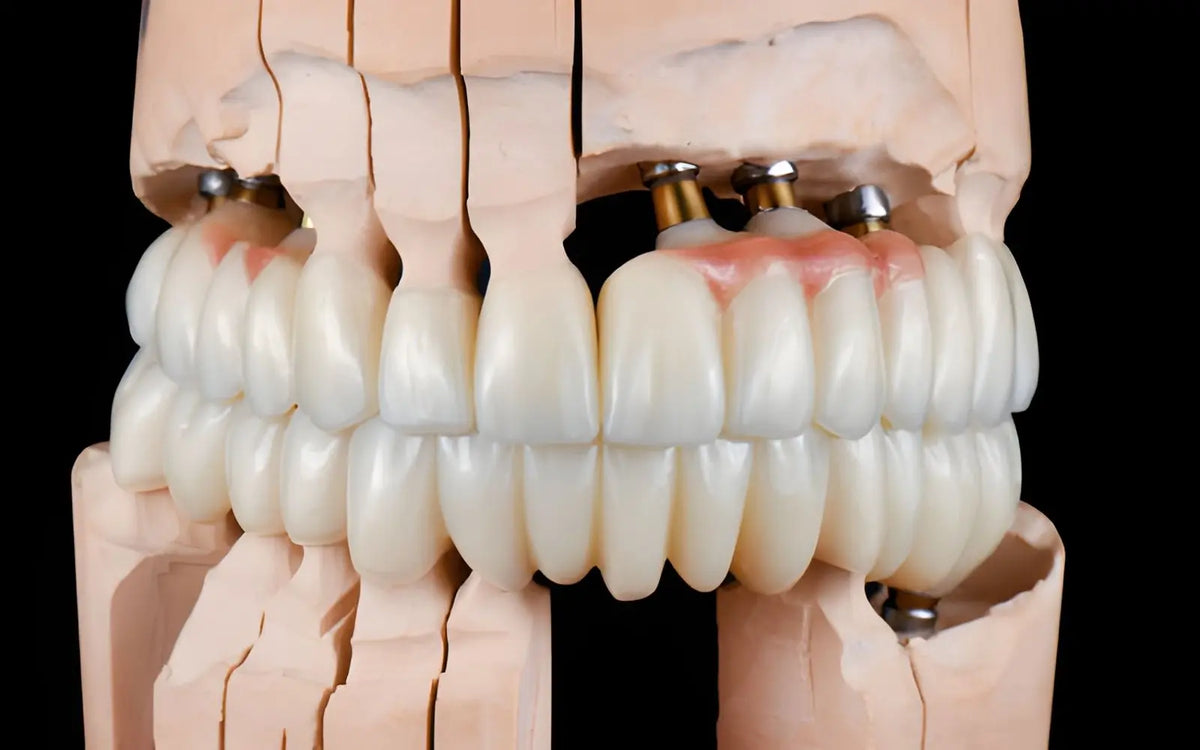 What to Look for When Choosing a Provider for Full Arch Dental