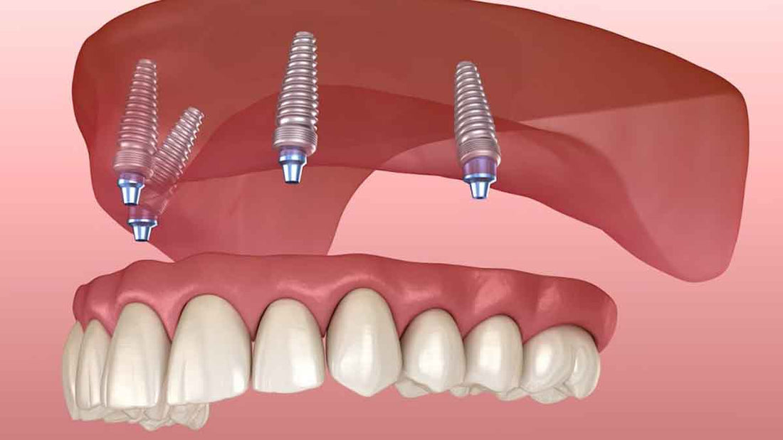 Best Toothpaste for All on 4 Implants - Grand Goldman