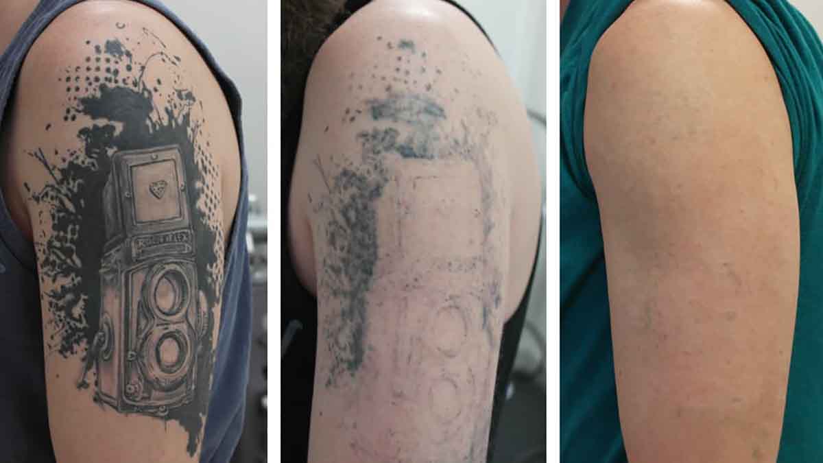 Best Tattoo Removal Technology - Grand Goldman