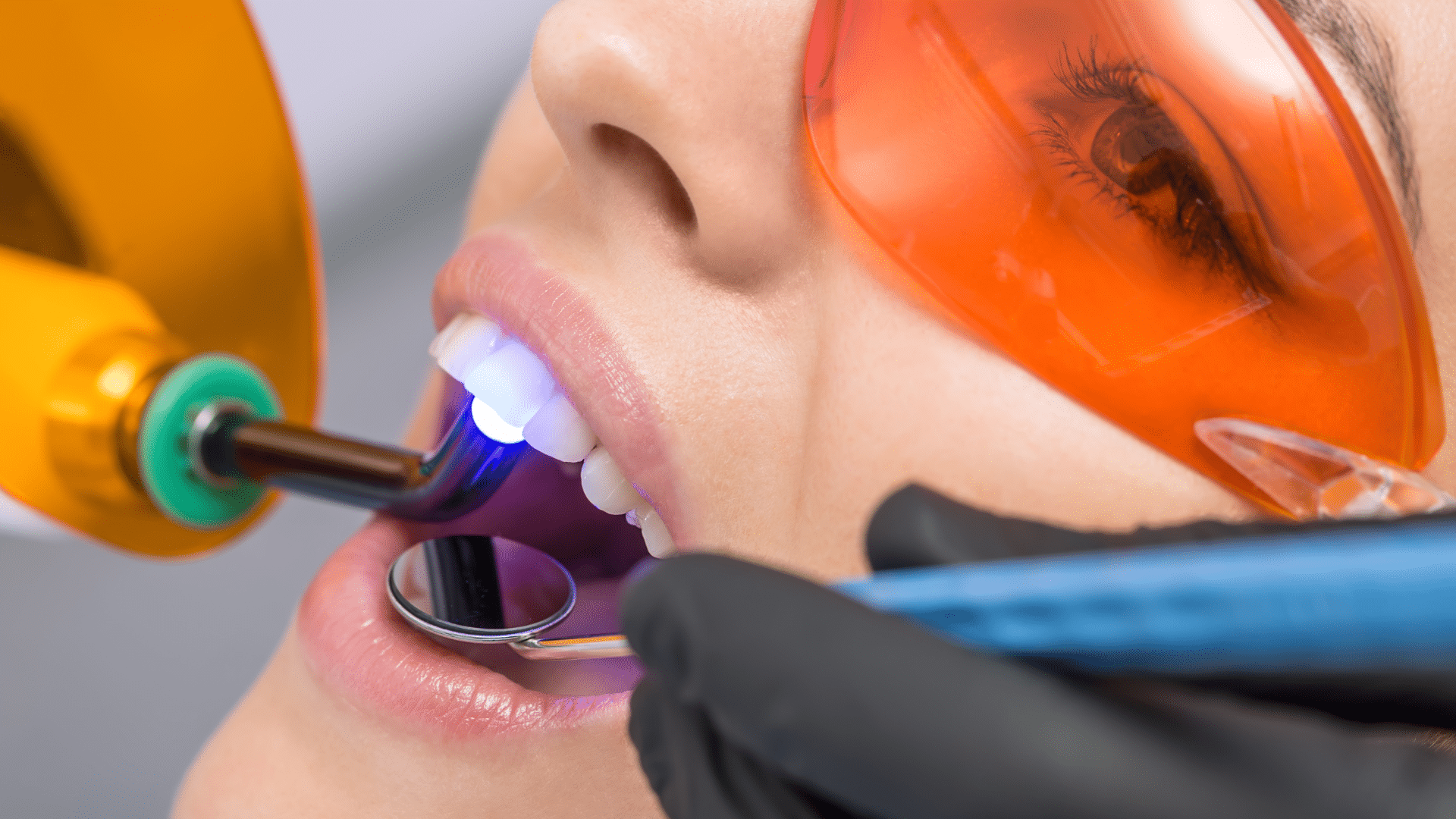 Tooth Bonding Cost With Insurance: Average Prices - grandgoldman.com